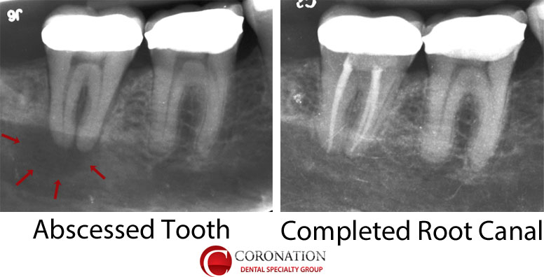xray of tooth abscess